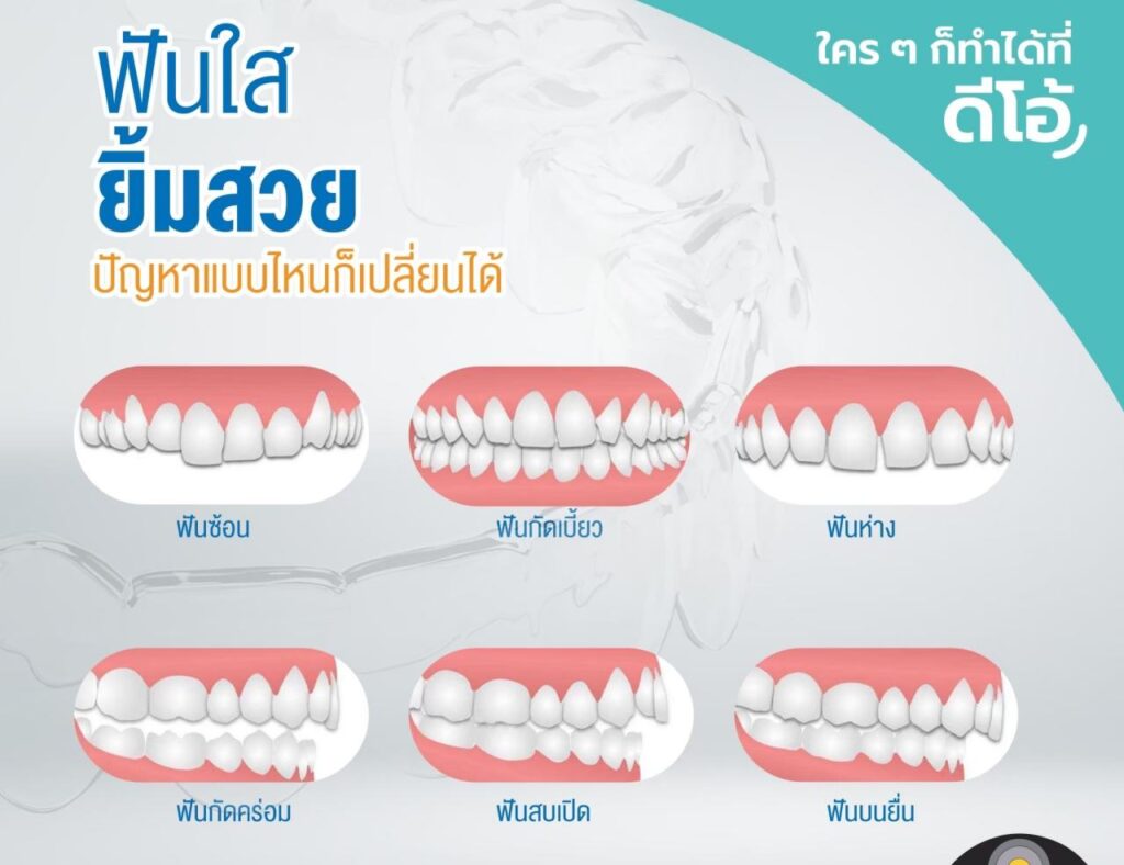 จัดฟันเหล็กเหมาะกับใครบ้าง