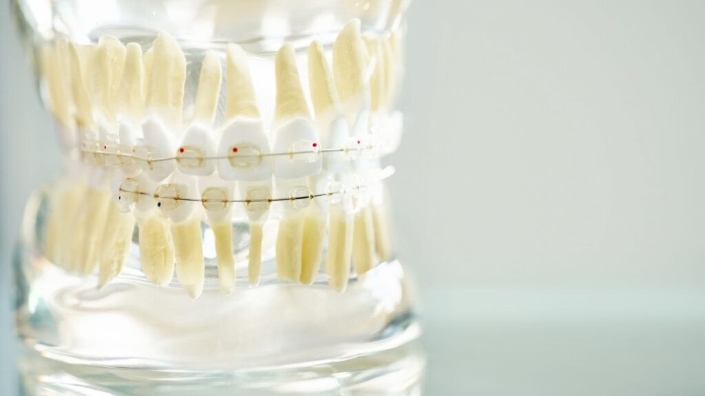 จัดฟันเซรามิก