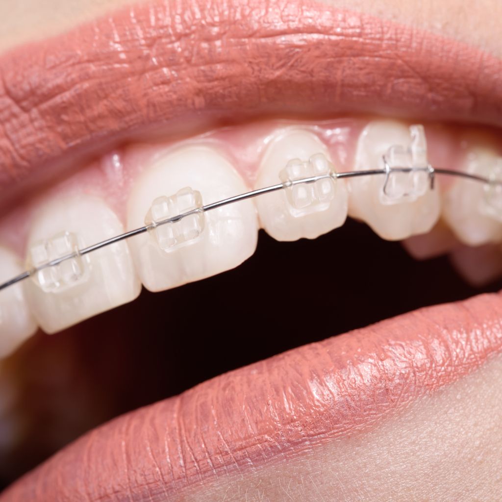 การจัดฟันแบบเซรามิก (Ceramic Braces) เหมาะกับใคร?